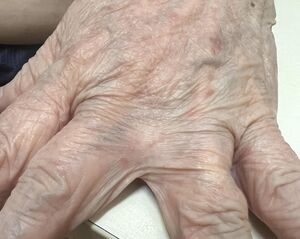 全身癢半年！醫驚見疥蟲「挖隧道產卵」　示警4大藏匿處