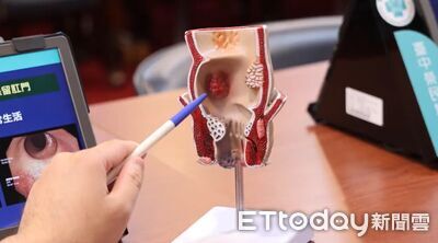 40歲男罹大腸癌3期「恐切肛門」 中榮TNT新療法「保肛成功」
