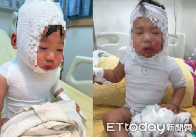 滾燙咖啡潑身！1歲半嬰「皮片片剝落」3度手術　母淚崩：像在地獄