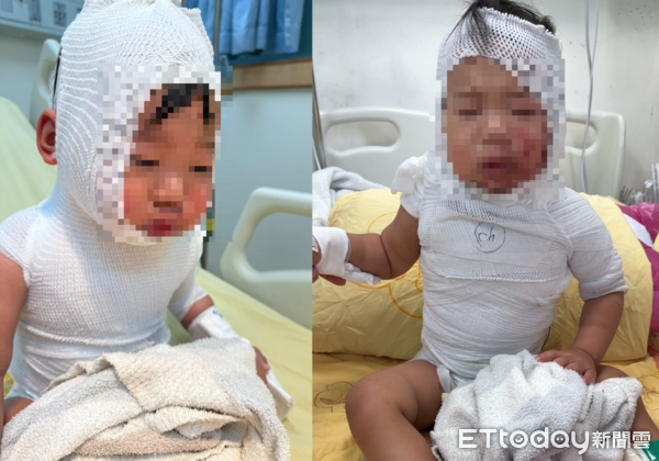 滾燙咖啡潑身！1歲半嬰「皮片片剝落」3度手術　母淚崩：像在地獄