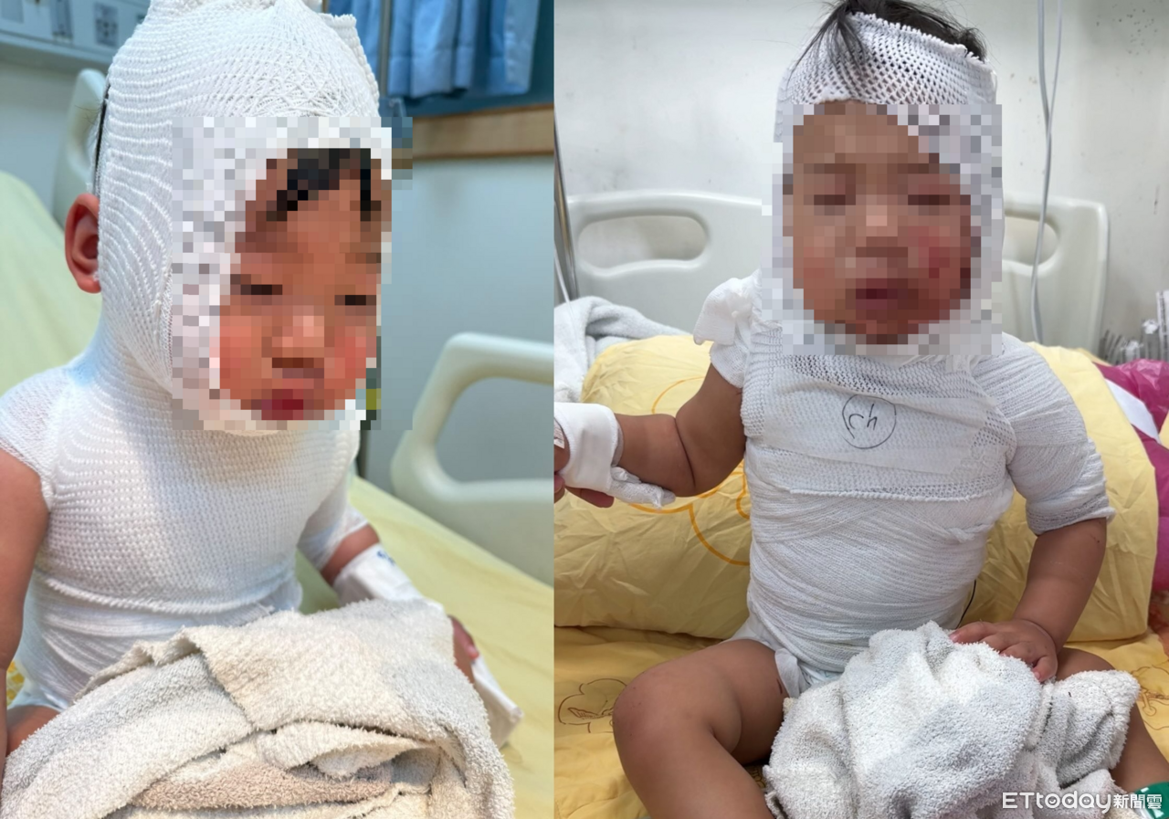 滾燙咖啡潑身!1歲半嬰「皮片片剝落」3度手術 母淚崩:像在地獄 | ETtoday生活新聞 | ETtoday新聞雲