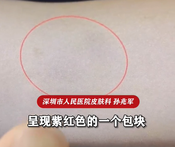 ▲女子手臂出現腫塊。（圖／翻攝自微博）