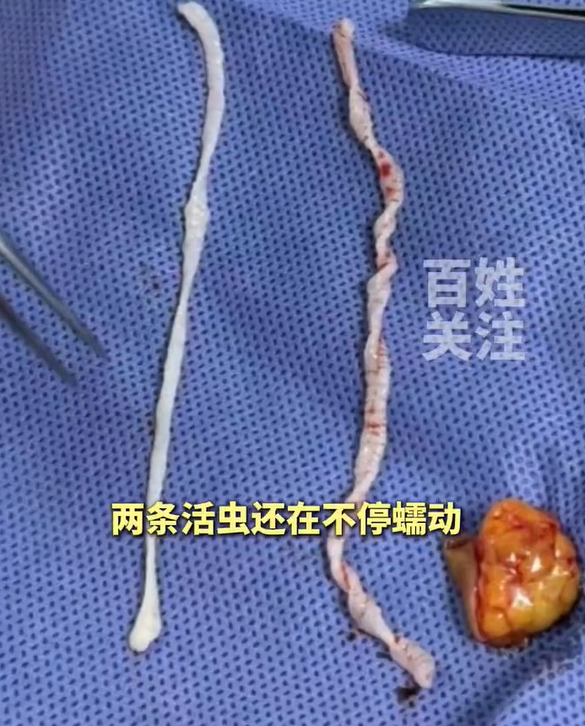 女子誤以為手臂長腫瘤「切開見2條10cm活蟲」 醫嚇喊:毛骨悚然 | ETtoday大陸新聞 | ETtoday新聞雲