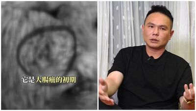 超哥驚爆罹大腸癌初期!急住院「前後切30cm」吐唯二遺憾:錢還沒花完