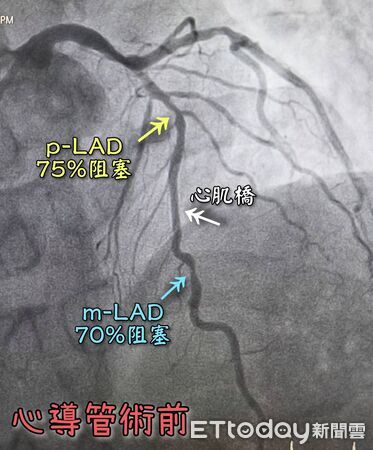 ▲▼壞膽固醇正常卻狂喘！45歲男「3條血管塞破5成」　醫驚揭基因殺手。（圖／曾國翔醫師授權提供，未經同意請勿任意翻攝）