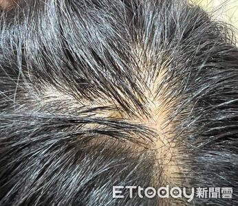 自備染劑也中鏢！她隔天「頭皮流湯暴癢」　醫嘆：免疫系統開戰了
