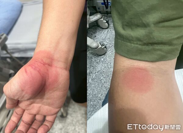 ▲▼固定性藥疹。（圖／李嘉文醫師授權提供，未經同意請勿任意翻攝）
