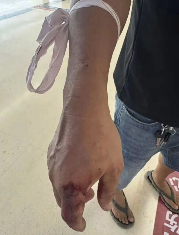 陸男子被眼鏡蛇咬傷活捉「現行犯」就醫 醫生:極其危險 | ETtoday大陸新聞 | ETtoday新聞雲