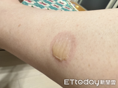 戳水泡根本「自毀防護罩」！專家揭3處理法：破了那層皮別撕