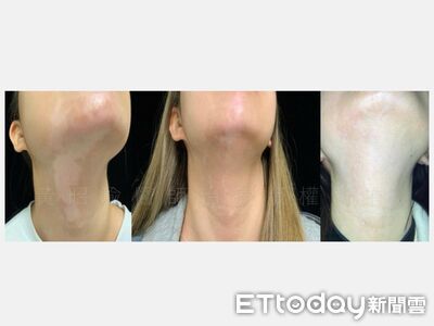白斑爬滿下巴與脖子!20歲女大生靠色素移植重拾自信