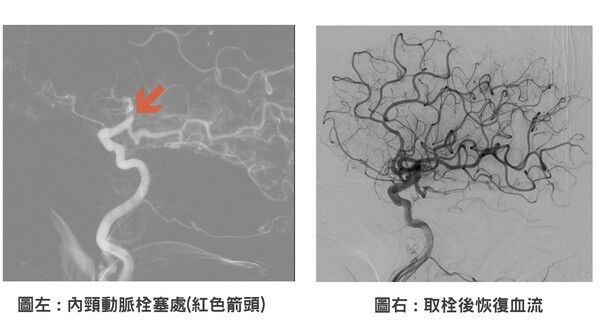 ▲70多歲婦打麻將突右半身癱瘓！聯新國際醫院87分鐘取栓救腦