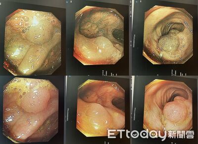 生父岳父皆癌逝!他無症狀「卻中4條件」 醫驚:腸內藏多顆息肉