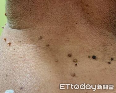 脖子狂冒醜肉芽！醫第一反應「有測血糖嗎」　3異狀別拖了
