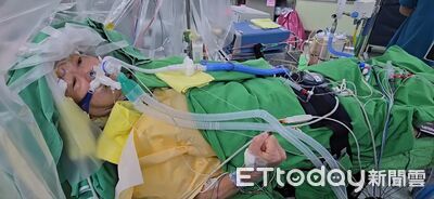 腫瘤像雞蛋黏腦部!台中男「5公分腦瘤」險癱 醫清醒開顱救命
