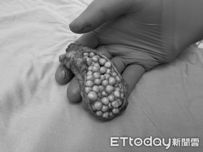 以為胃痛!女膽囊塞爆130顆「玉米狀結石」 醫警告5類人危險