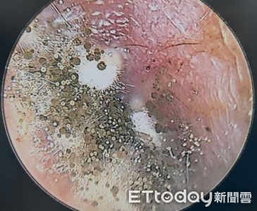 癢爆!30歲男耳道塞滿「整座黴菌園」 醫看傻:少用棉花棒