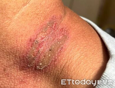 誤拍隱翅蟲!男脖子「烙印2條焦痕」痛爆 醫警告:毒液如強酸