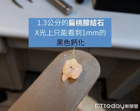 ▲不只爆臭！40%人喉嚨藏「黃色軟渣」惹全身痛　醫10題測結石風險。（圖／李晏廷醫師授權提供，未經同意請勿任意翻攝）