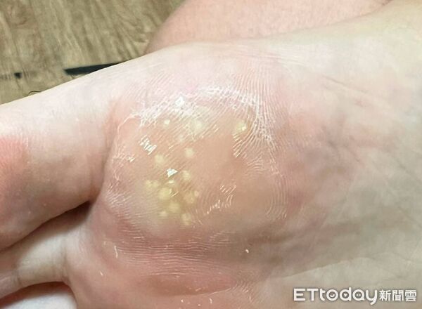 ▲她腳底長「整片假雞眼」走路會痛！醫一摸：是病毒在開趴。（圖／吳仁欽醫師授權提供，未經同意請勿任意翻攝）