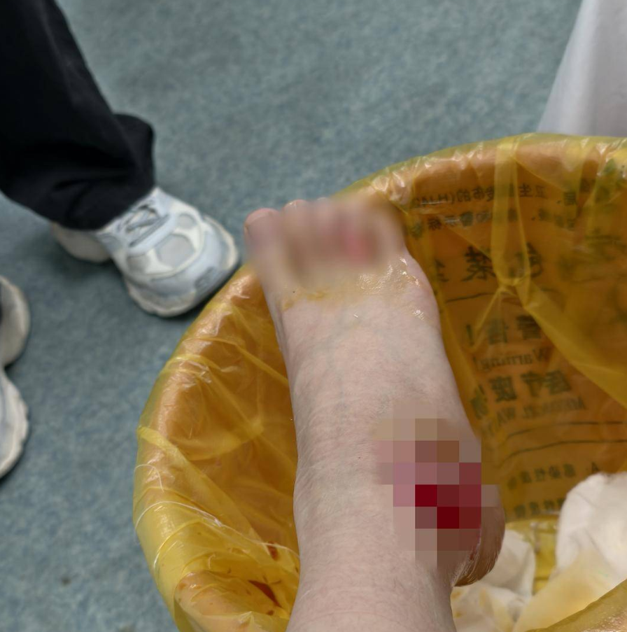 ▲▼情侶喇舌打翻火鍋！　熱湯燙淋女客「一吻代價21萬」。（圖／翻攝自揚子晚報）