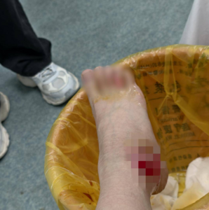 情侶喇舌打翻火鍋！　熱湯燙淋女客「一吻代價21萬」