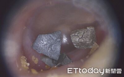 同學撿「地墊碎塊」撒頭！8歲弟耳卡4尖銳物　醫急喊2動作別做