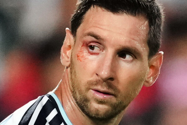 ▲梅西（Lionel Messi）前役對瑞士時眼眶遭肘擊濺血。（圖／達志影像／美聯社）