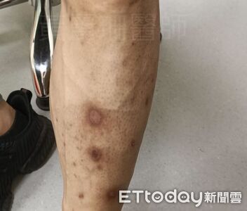 自認很健康！男小腿冒「無感咖啡斑」　醫一驗：糖化血色素飆12%