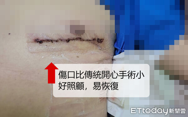 ▲東港安泰醫院微創心臟繞道手術。（圖／安泰醫院提供）