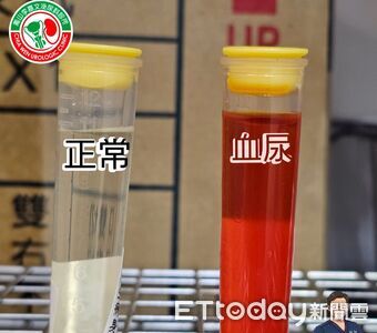 20多歲男「尿出整管鮮紅」怕是癌!醫揭血尿5原因 不痛最危險