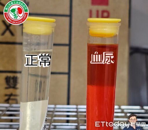 ▲年輕男「尿出整管鮮紅」怕是癌！醫揭血尿5原因　不痛反而最危險。（圖／蘇信豪醫師授權提供，未經同意請勿任意翻攝）