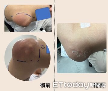 痛風石藏10年！台中男右手痛炸開刀　驚見整窩「BB彈+鵪鶉蛋」