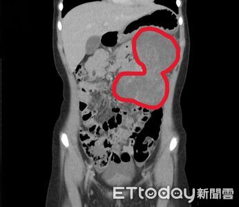 9歲童腹痛「15公分腫瘤」侵犯大腸 醫示警6症狀:別當腸胃炎