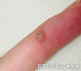 皮膚凸起黑點會傳染!網曝「曾看人狂摳」嚇壞 醫示警:還生小疣