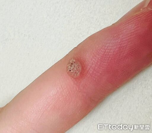 ▲▼手指凸起冒黑點！網崩潰「自挖到流血」　醫示警：會傳染生小疣。（圖／吳仁欽醫師授權提供）