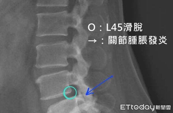 ▲林新醫院急重症神經外科主任李俊明指出，腰椎滑脫可能造成神經壓迫，引發坐骨神經痛及下肢麻木症狀。（圖／記者游瓊華翻攝）