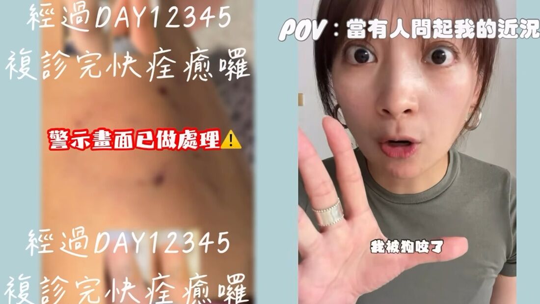 阿喜被狗咬「傷勢照曝光」　揭驚險過程：我原來這麼偉大