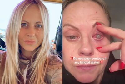 忘摘隱形眼鏡！英女遭「寄生蟲啃食眼角膜」　右眼全失明