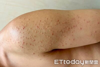 手臂爆「芝麻粒紅疹」!20多歲男擦藥2個月沒好 醫問職業揪元凶