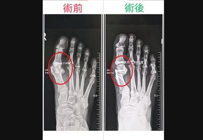 鞋子穿太緊出事!台中男腳趾變形「放鳥山友」 醫曝驚悚X光照