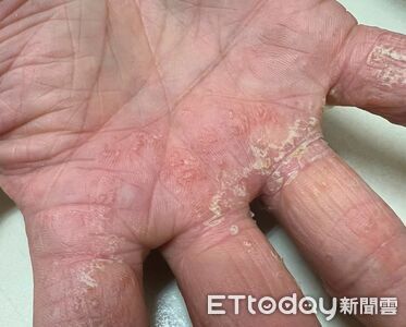 手掌狂冒「超癢小水泡」!沒碰水也中 醫揭真相:根本不挑人