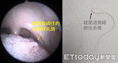 喝飲料突被勾住！男「長髮纏舌根」痛慘　醫一照驚：打死結了