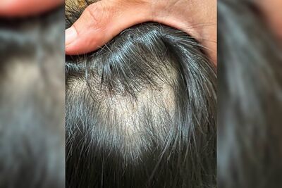 8歲童「頭上長鐘乳石」母崩潰！皮膚醫示警：硬摳恐害禿頭