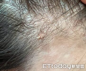 手癢摳破！她額頭「痘痘變小菜花」　醫揭元凶：就這麼簡單粗暴