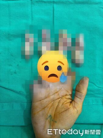 ▲買豬肉突出事！男客人「4指絞爛」捧斷肢衝急診　醫嘆：只能放棄。（圖／朱育瑩醫師授權提供，未經同意請勿任意翻攝）