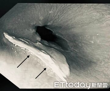 魚刺才剛夾出!男怕浪費吃剩魚「隔天又吞1根」 醫傻眼:別吃了