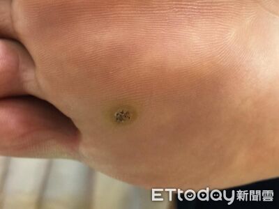 腳底長1顆硬硬的…醫揭「唯一會傳染」4特徵：亂剪越長越多