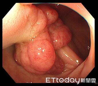 完全沒症狀！他腸鏡一照「塞10多顆息肉」　醫嘆：大腸癌長大中