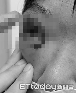 國一生折斷掃把打老師濺血！驚悚傷勢畫面曝　女師恐失明將提告