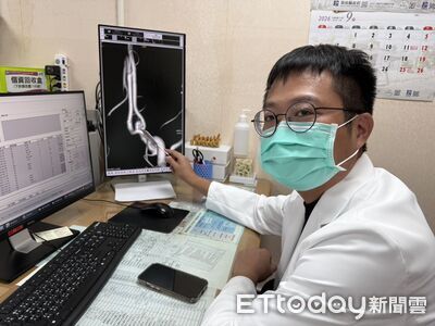 婦人顱內動脈瘤破裂　南投醫院首例經動脈栓塞術治癒